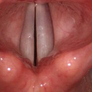 Vocal Damage: Nodes or other….